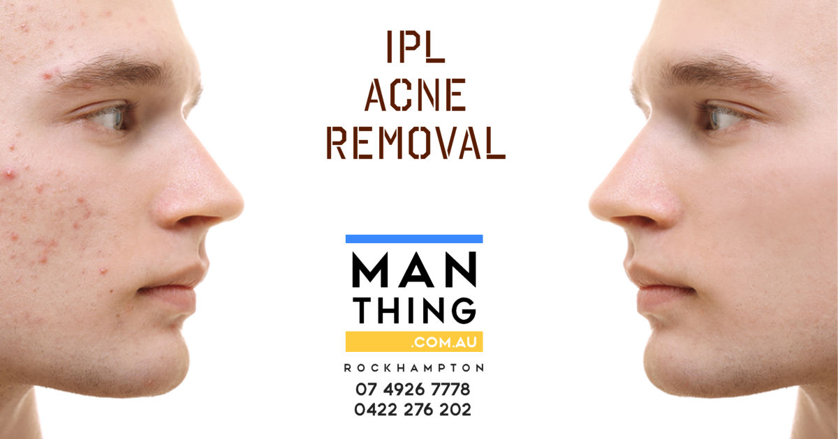 IPL Acne Removal treatments at Man Thing Rockhampton