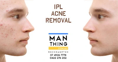 IPL acne removal treatments available at Man Thing in Rockhampton