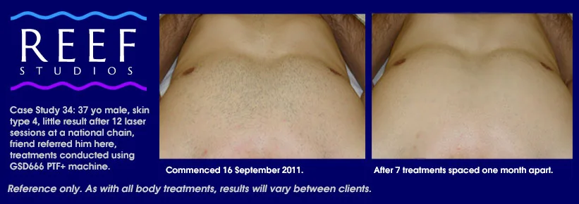 IPL Laser Hair Removal - Chest and Stomach Case Study