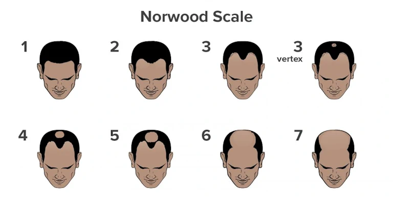 Norwood Scale for measuring male pattern baldness