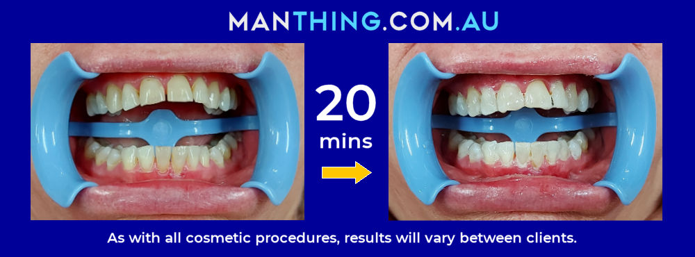 Teeth whitening Rockhampton before and after photos, female 1